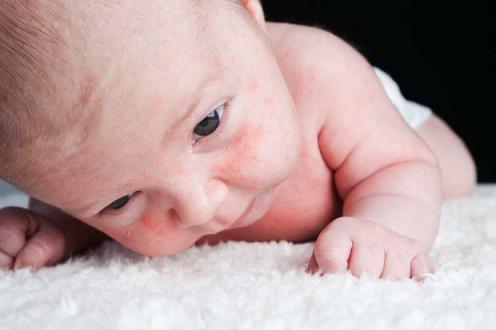 什么是婴儿奶斑?