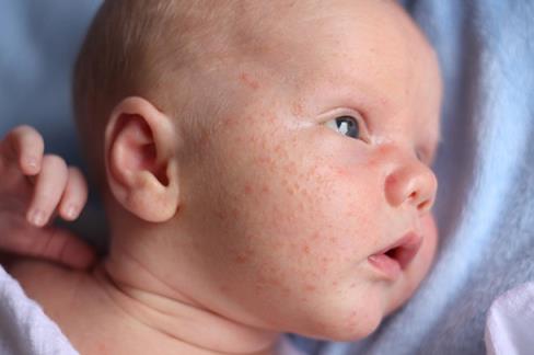 why-does-my-newborn-have-acne_190375