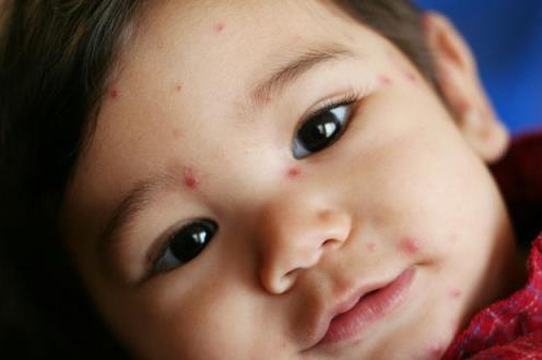 水痘和其他儿童疾病
