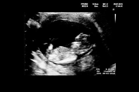 12周怀孕日期扫描:以下是预期结果
