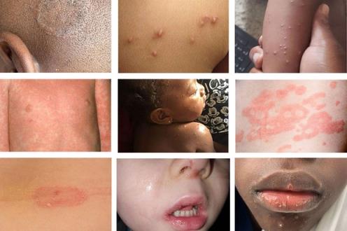 儿童、幼儿和婴儿照片中的斑点和皮疹