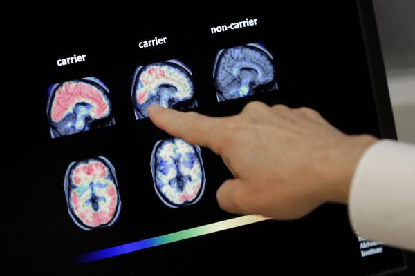 Doctor looks at PET brain scans in Phoenix